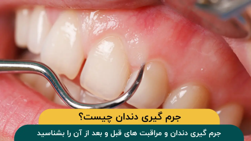 جرم-گیری-دندان-چیست-و-چگونه-انجام-می-شود